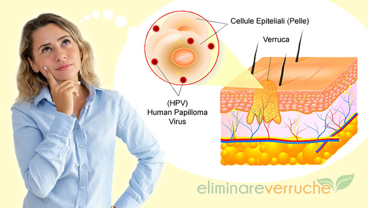 cosa sono le verruche